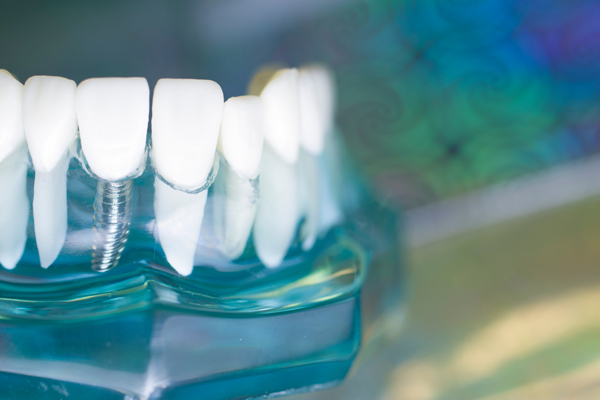 Dentures Vs  Dental Implants: Which Is The Right Choice For You?