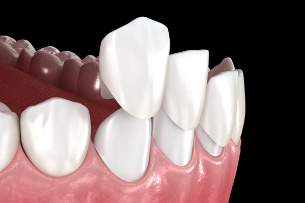 Common Dental Veneer Myths, Debunked